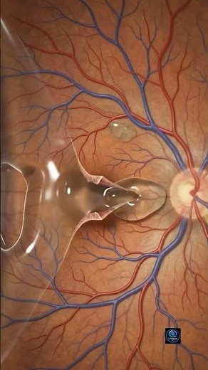 How Can a Tiny Retinal Tear Create a Dark Curtain Across Vision? | 3D Animation