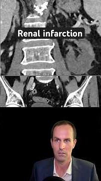 Abdominal CT Tutorials - Renal infarction