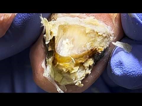 😲The Patient's Toenails Were Like Mountains And There Were Bugs!【Xue Yidao】