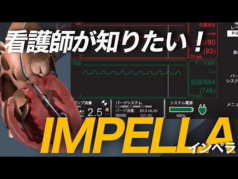 IMPELLA（インペラ）の管理と看護について要点を絞って解説！