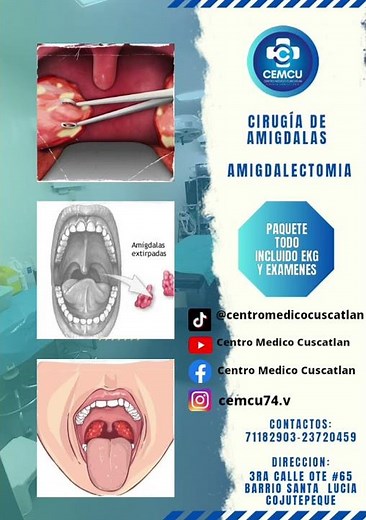 Cirugía de amigdalas ( Amigdalectomia ) #cirujano #amigdalas #bajocosto #cirugiasegura