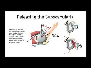 How To Do a Total Shoulder #1: Patient Positioning and Surgical Approach