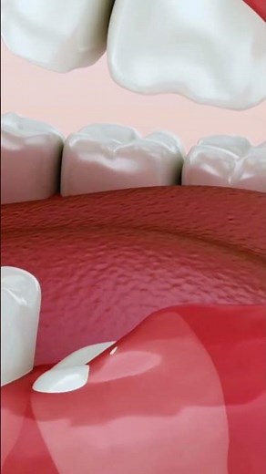 "Pericoronitis Explained in 25 Seconds | Wisdom Tooth Gum Infection" #shorts