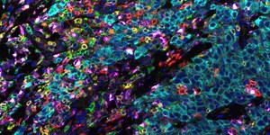 Spatial Protein and RNA Profiling: Seeing the Unseen in the Tumor Microenvironment