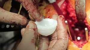 Surgeon Installs Polyethylene Liner Acetabular Cup Stock Footage Video (100% Royalty-free) 1049188753 | Shutterstock