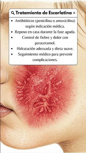 ¿Como tratar la escarlatina? #escarlatina #medicina #salud