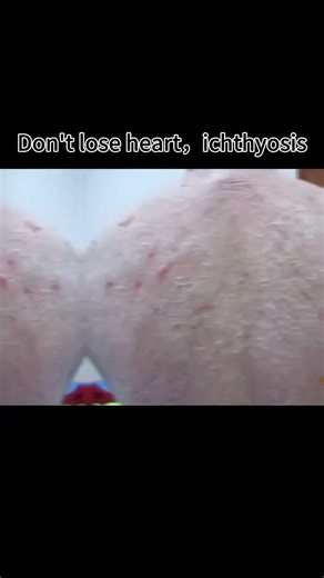 Don’t lose heart, ichthyosis #IchthyosisTreatment,#Ichthyosis,#IchthyosisVulgaris#LamellarIchthyosis