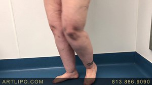 #LIPEDEMA TREATMENT by LIPOSUCTION!!💥ULTRA-COMPLETE, HIGH-DEFINITION, AWAKE #LIPOSUCTION of the #Ankles, and #Calves aka #Cankles, and #Knees Complex performed by Liposuction Specialist #DrThomasSu. Slimmer and shapelier #Legs are Possible! See Your Results Immediately!! Minimal Downtime!@artisticlipoandplasticsurgery! Call us today ☎️813-886-9090 or visit ➡️Artlipo.com to schedule a complimentary consultation! Long Distance consultations available! You can send us your photos for evaluation to