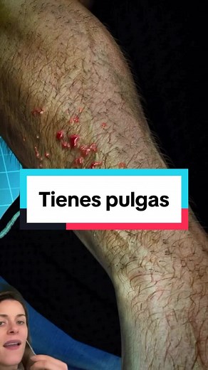Tratamiento y cuidados para la escabiosis