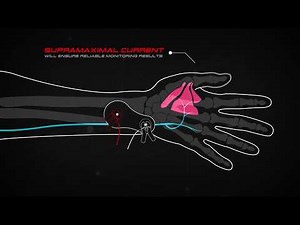 MedTech Stimpod TOF Train of Four Monitoring Ulnar Nerve