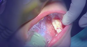 Pediatric Dentistry with Zyris Isolite - Zyris - Makers of the Isolite System