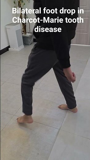 Bilateral foot drop ( high steppage gait )