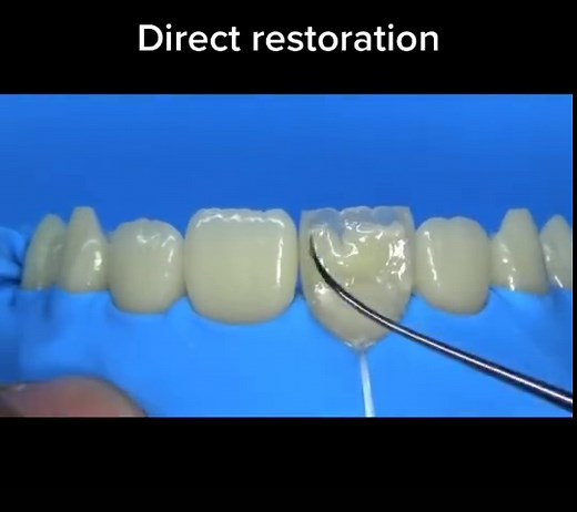 Step-by-Step Guide to Direct Composite Restoration Class 4