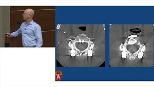Lateral Mass Screw Fixation
