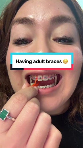 Embracing Adult Braces: A Transformative Journey