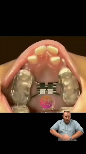 Expander pain? Tell me bout it #ortholab #orthodontist #foryou #fyp #foryoupage #ortholab #expander #rpe #orthodontic