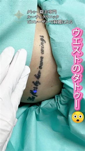 タトゥー除去ウエスト#タトゥー除去#刺青除去#タトゥー消す#ピコレーザー#タトゥー除去レーザー#刺青#tattooremoval #エンライトン3#刺青消す#タトゥー除去モニター