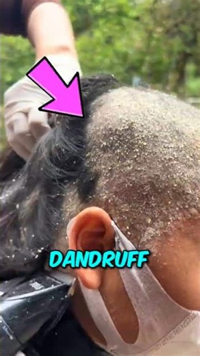 Dandruff Truth Revealed Fast ‼️😱
