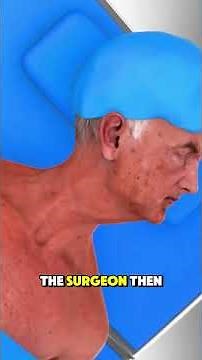 How Carotid Endarterectomy Is Performed | Step-by-Step Surgical Explanation #medicaleducation