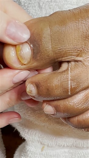 A lifted toenail doesn’t automatically mean permanent damage. With proper trimming, protection of new growth, and maintaining a healthy nail environment, reattachment is possible as the nail grows forward. This transformation happened over three pedicure services — not magic, just method. When nail professionals understand why nails lift and how to prevent further separation, results change. Knowledge changes outcomes. | The Meticulous Manicurist Nail Tutorials