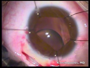 Pediatric Ectopia Lentis Cataract Extraction With Artisan Aphakia IOL Implantation - Eyetube