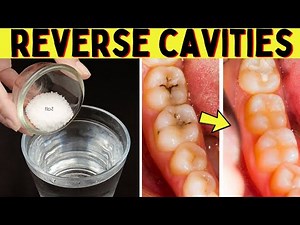Effective Way To Get Rid Of Cavities And Heal Tooth Decay Naturally - Stop Tooth Decay