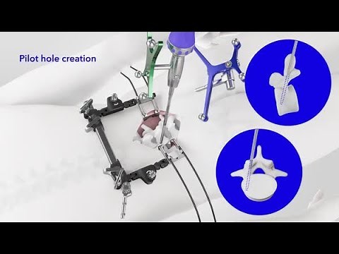Animation: CD Horizon ™ ModuLeX™ 5.5mm Spinal System