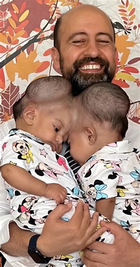 66K views · 331 reactions |  Conjoined twins with fused brains...