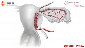Learn essential embolisation techniques to stop arterial bleeding. Every second counts in an emergency – be prepared, stay informed! know more at www.ravnindersinghkuka.com Call: 095013 89026 | Dr Ravninder Singh Kuka