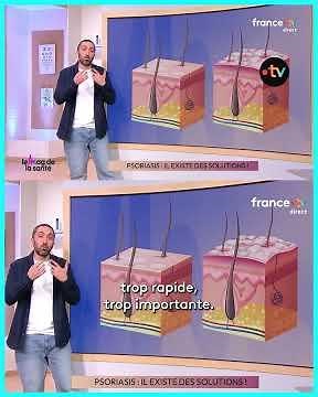 Qu'est-ce que le psoriasis ?