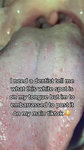 Understanding White Spots on the Tongue: Causes and Remedies