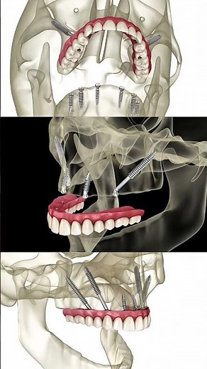 Upper jaw implants — fixed prosthesis. Denture attachment explained. #dentist