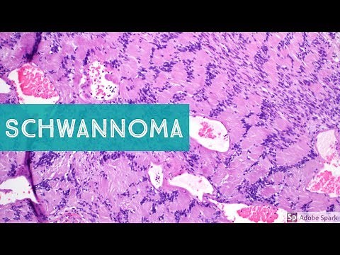 Schwannoma (Neurilemmoma)...Explained by a Soft Tissue Pathologist