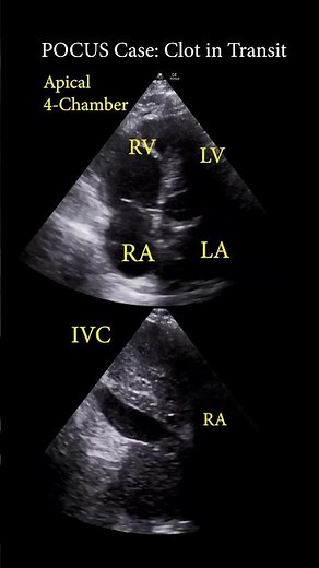 Clot in Transit #pocus #cardiology #emergencymedicine