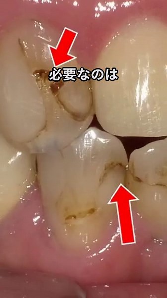 ラクトバチラス菌の基礎知識｜虫歯進行メカニズムと最新ケア方法まとめ #ラクトバチラス菌 #虫歯 #乳酸桿菌