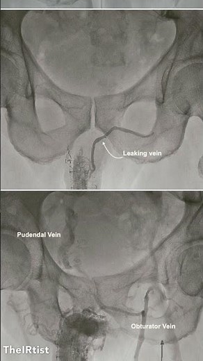 Treatment of Erectile Dysfunction due to Venous leakage