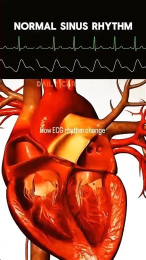 How ECG rhythm change🤯🤔, #ecg #heart #blood #shorts #medical #biology #viralvideo #shortsfeed #viral