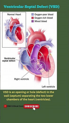 Ventricular Septal Defect|VSD|Type of Congenital Heart Disease|CHD|DM Critical Care #vsd #chd