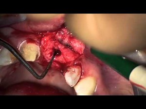 Delayed Implant Placement - Bone Manipulation with Osteostomes • Video • MEDtube.net