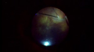 Phakic Retinal Detachment - Eyetube