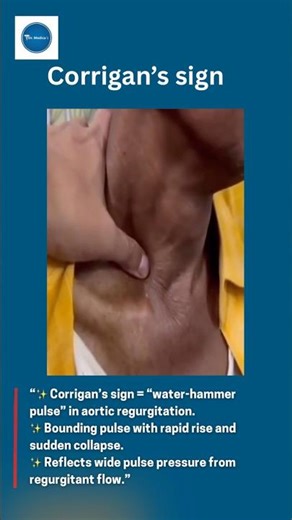 Corrigan’s Sign || #youtubeshorts #youtube #youtubeshort #diagnosis ||