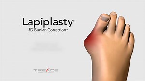 Lapiplasty® Procedure