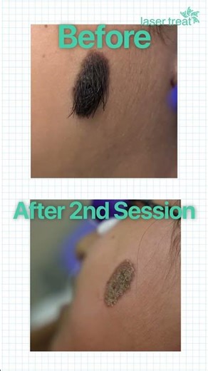 Laser Birthmark Removal | 80% Improvement After 2 Sessions