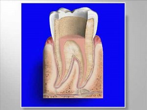 Root canal (Tratamiento de conducto, Endodoncia) in spanish by west palm beach dentist