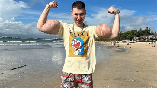 Russian 'Popeye' faces losing BOTH arms after pumping them with oil