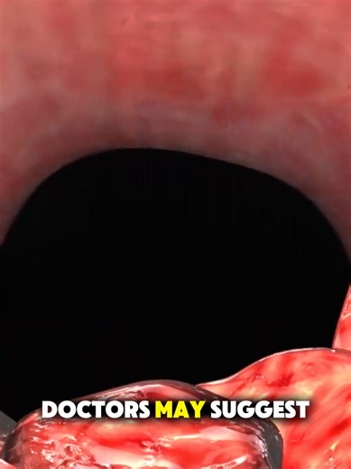Understanding Enlarged Prostate with 3D Animation