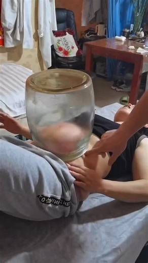 🔥 Fire cupping uses heat to create a negative pressure (vacuum) inside glass or bamboo cups. A flame is quickly introduced into the cup to heat the air, then removed immediately before placing the cup on the skin. As the air inside the cup cools rapidly, it contracts—this creates a suction effect that draws the skin and superficial muscle layer into the cup. Note: We do not perform fire cupping at our office—this post is for educational purposes only. #FireCupping #MyofascialRelease #Chiropract