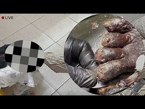 🤯 Jigger Infestation Horror – Skin Full of Parasites #XG325