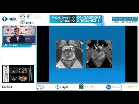 Πολυπαραμετρική Μαγνητική Τομογραφία: Διλήμματα & παγίδες στη διάγνωση καρκίνου προστάτη | Λάσπας Φ.