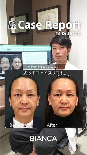 人生1度の施術でヒアルロン酸、脂肪注入いらずの最強治療、ミッドフェイスリフトをご説明します